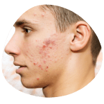 Home Acne Scar Treatment