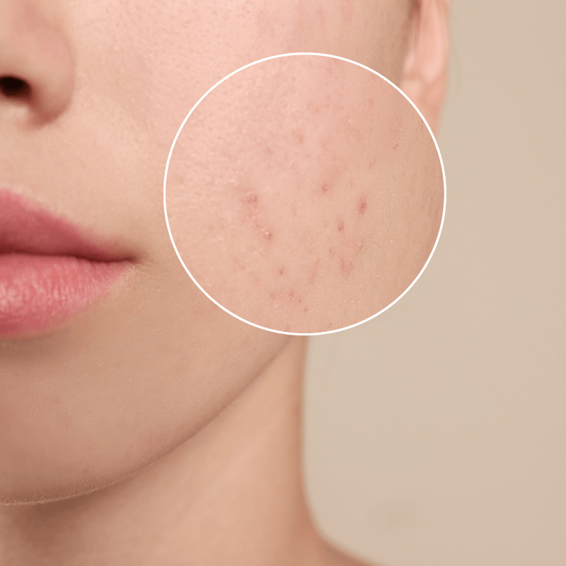 Home Acne scar removal clnic in bangalore