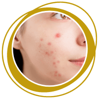 Acne scar treatment near bangalore