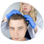 Home Alopecia Areata treatment