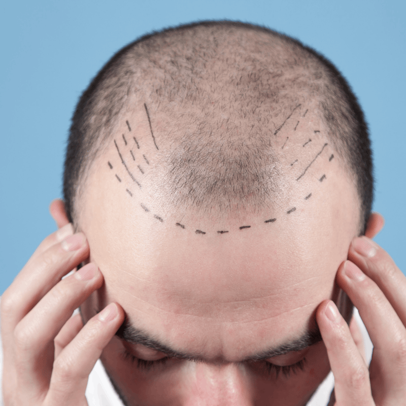 Home Assured result Hair Transplant treatment in bangalore