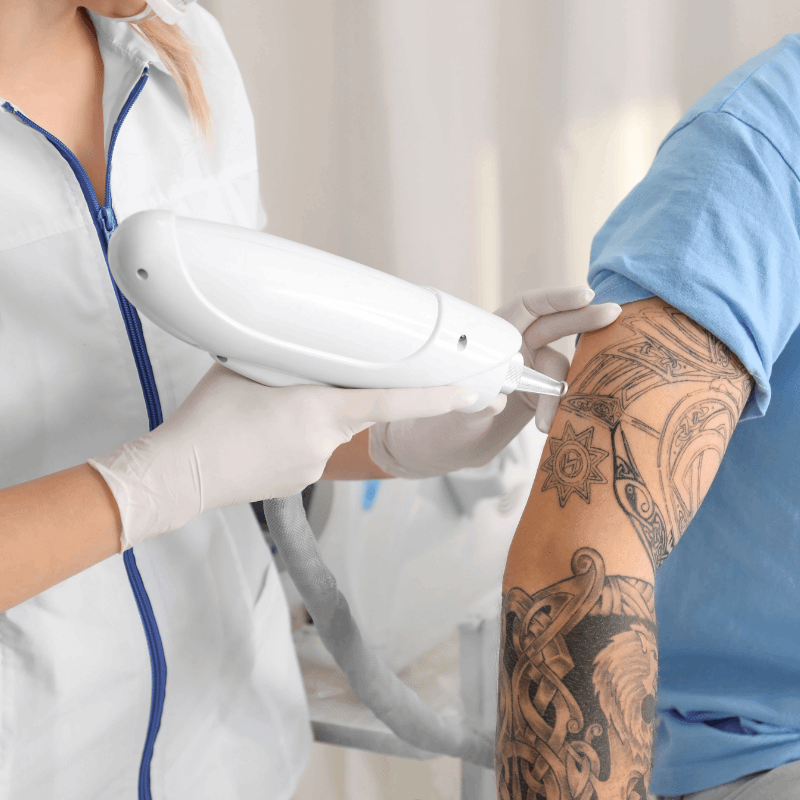 Home Permanent Tattoo remoal clinic in bangalore