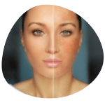 Home Pigmentation Treatment clinic in bangalore