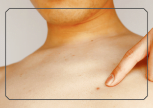 Acne on chest