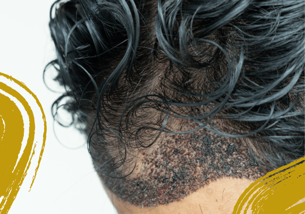 Best Hair Transplant service in Bangalore (1)