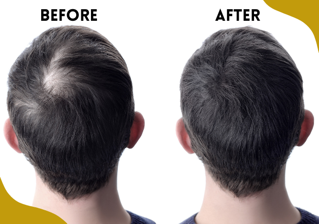 Before and After image of FUE Hair Transplant