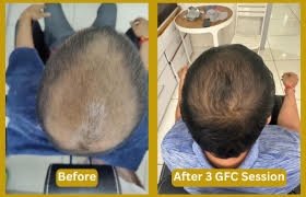 GFC Treatment In Bangalore ht