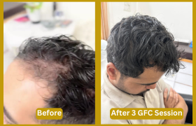 GFC Treatment In Bangalore ht1